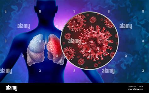 Brote De Neumon A Infecci N Pulmonar Pat Gena Del Virus E Infecciones