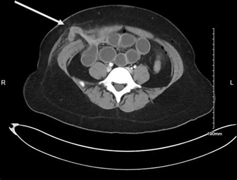 Trocar Site Hernia After Laparoscopy Early Recognition Prevents