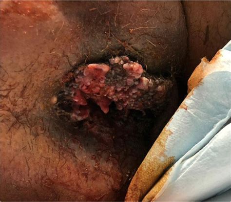 Case Report Consequences Of Misdiagnosed Anal Cancer AAFP