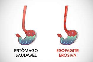 O Que Causa Esofagite