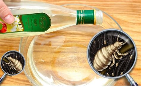 Vinagre E Bom Para Piolho - Como Usar Vinagre Para Acabar com Piolhos e Lêndeas | Dicas de Saúde