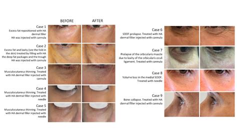 Undereye Tear Trough Filler What You Should Know