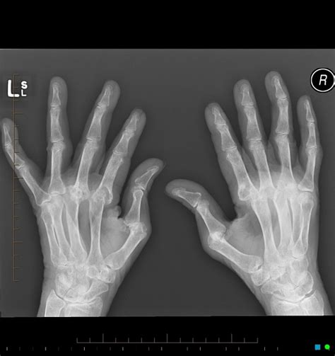 Rheumatoide Arthritis Pacs