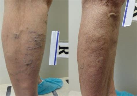 Before And After Texas Vein And Wellness Institute