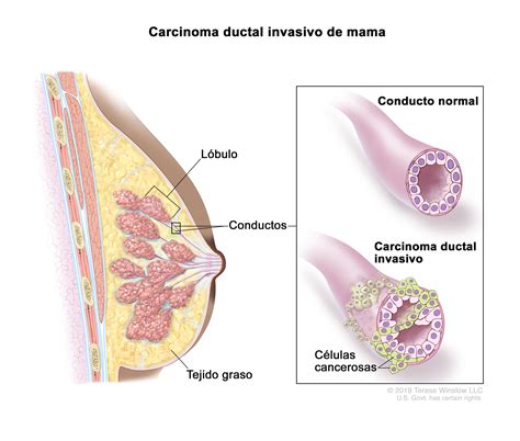 Definici N De Carcinoma Ductal Invasivo Diccionario De C Ncer Del Nci