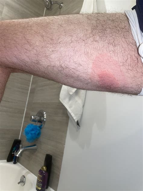 Lyme? Spider bite? Something else? : r/Lyme