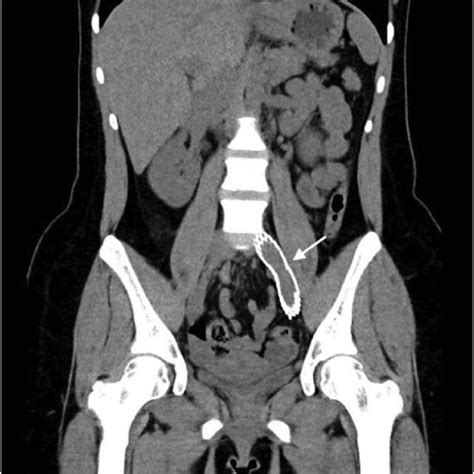 Abdominal Computed Tomography Showing Left Common Iliac Vein