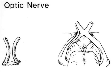 Absence Of Optic Chiasma. Bilateral Asymmetric Distribution of Nerve ...