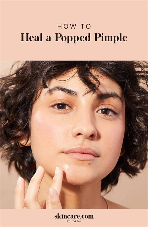 How To Heal A Popped Pimple Acne Around The Mouth Acne Skin Acne