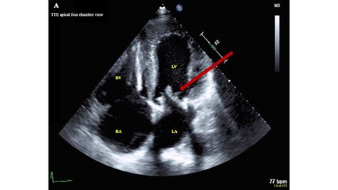 Recurrent Bioprosthetic Mitral Valve Thrombosis Treated with Anticoagulation - Authorea