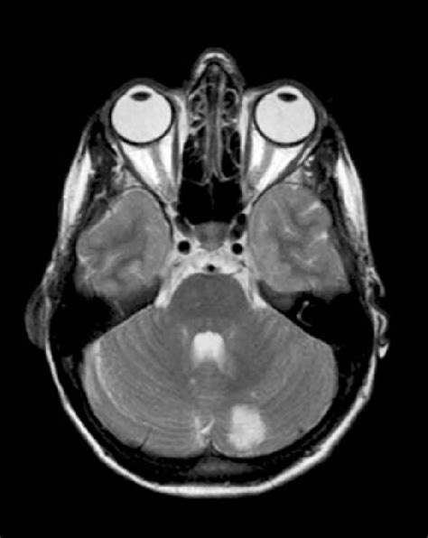 Brain MRI: infarction around the left cerebellar artery. | Download ...