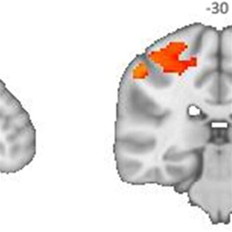 Group Difference ICA After Whole Brain Back Projection Essential