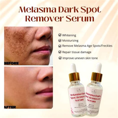 melasma dark sport remover serum ml shopee philippines
