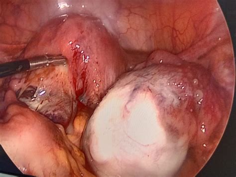 Chocolate Ovarian Cyst