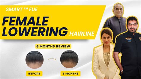 6 Months Female Lowering Hairline Hair Transplant Malaysia Youtube