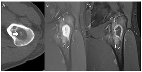 Classification of Chondrosarcoma: From Characteristic to Challenging