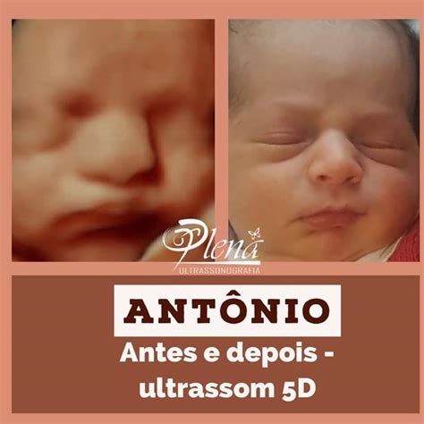 Clinica Plena Ultrassonografia Niterói Rj Galeria De Ultrassom 3d