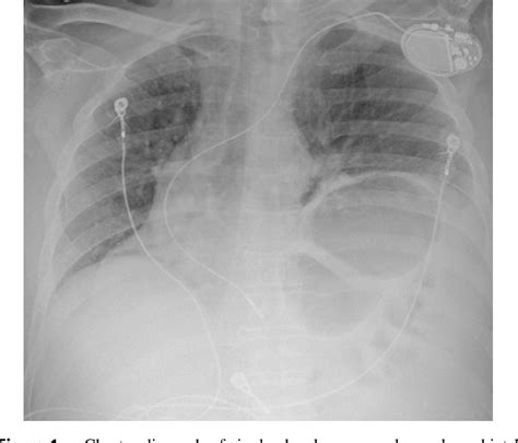 Malpositioned Endocardial Left Ventricular Pacing Lead Extraction With