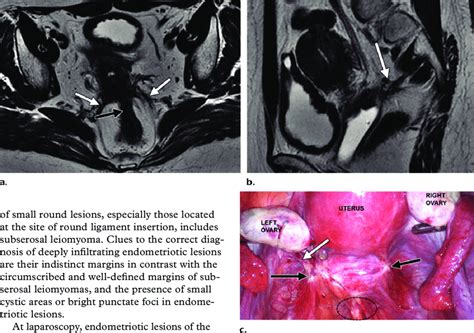 Bilateral Retrocervical Deeply Infiltrating Endometriosis In A