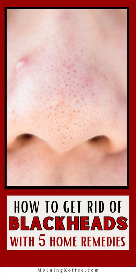 How To Get Rid Of Blackheads Naturally Artofit