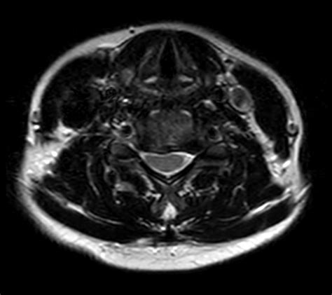 Cervical Spine Imaging With Robust Fatsat Philips Mr Body Map