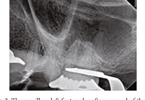 Figure From Nonsurgical Management Of Apical Root Perforation Using