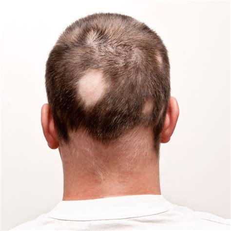 Alopecia Universalis Men