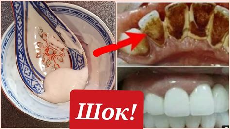 КАК ОТБЕЛИТЬ зубы ЗА 2 МИНУТЫ и избавиться от ЗУБНОГО КАМНЯ И запаха ...
