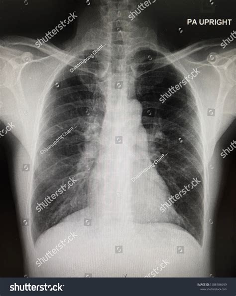 1,085 Copd Xray Images, Stock Photos & Vectors | Shutterstock