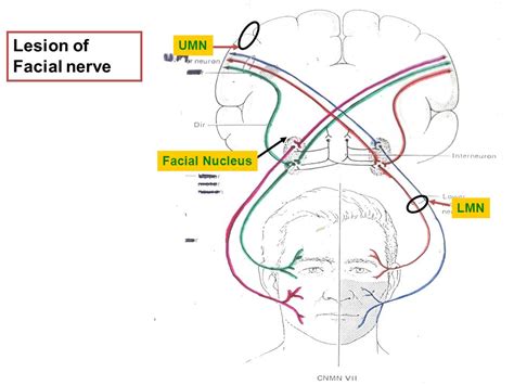 Lesion Of Facial Nerve Umn Facial Nucleus Lmn