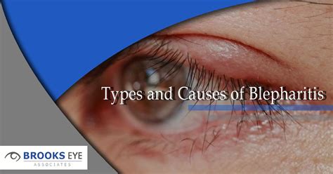 Blepharitis Types Causes Symptoms Diagnosis And Treatments Nbkomputer