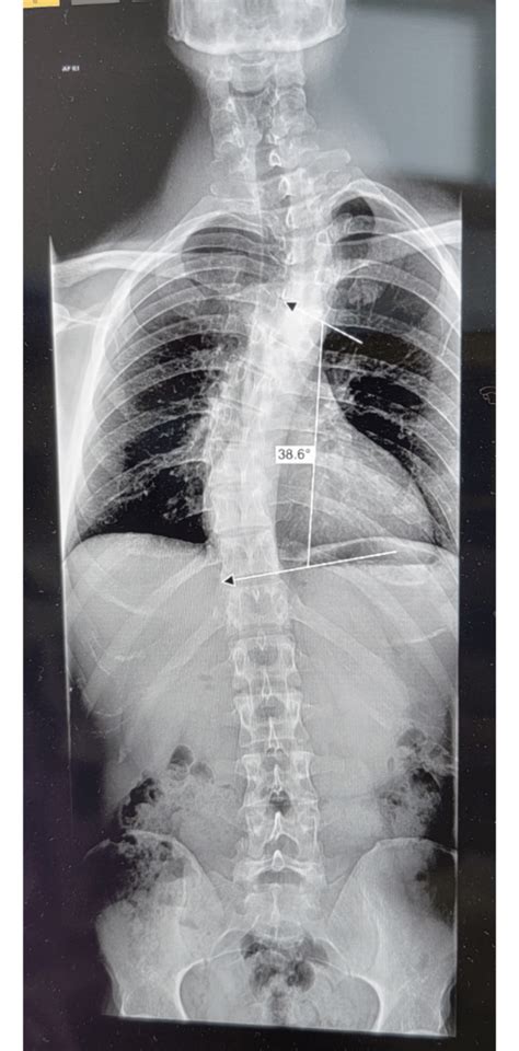 Thoracic Scoliosis Rscoliosis