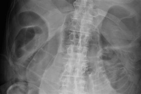 Abdominal Radiograph