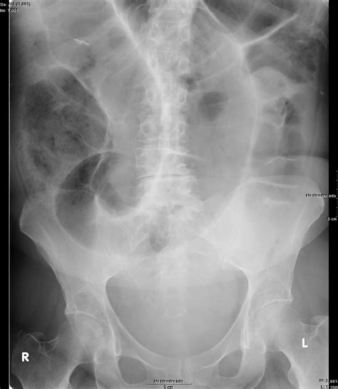 Sigmoid Volvulus Image