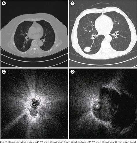 Figure 2 From Utility Of Radial Probe Endobronchial Ultrasound Guided