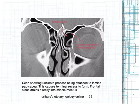 Radiological anatomy of frontal sinus | PPT