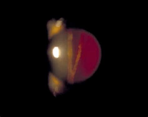 Band Exudates Within The Base Of The Vitreous Body Download