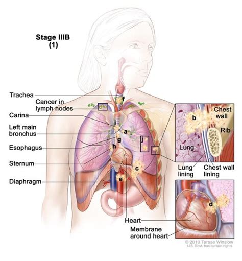 Lung Cancer What To Expect With Cancer