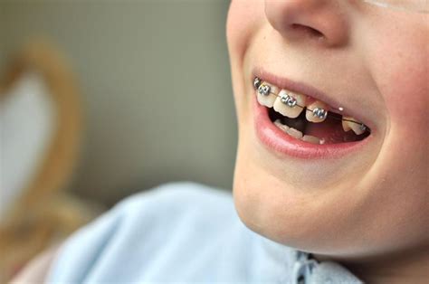 Orthodontic Services In Fort Payne Al Skelton Orthodontics