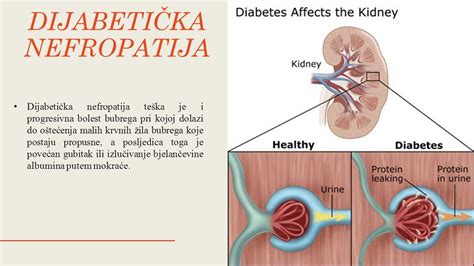HroniČne Komplikacije ŠeĆerne Bolesti Ppt Download