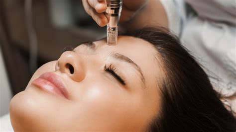 What You Need To Know About Vivace Rf Microneedling