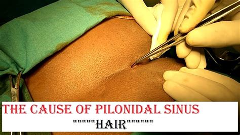 Pilonidal sinus cause| Hair| Avoid excessive hair|Personal hygiene ...