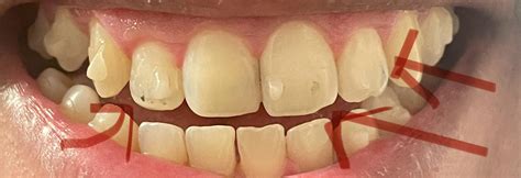 greyblack spots   teeth