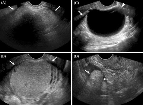 Ultrasound Examples Of Lesions With Refractive Edge Shadow A Grayscale