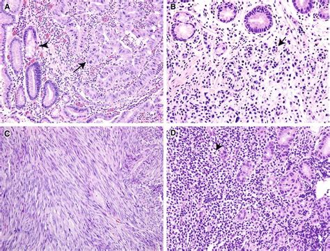 Pathology Of Gastric Tumors A Papillary Adenocarcinoma The Tumor Is