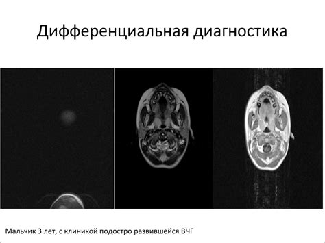 Гидроцефалия