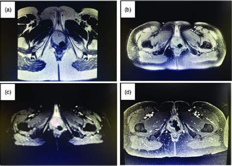 Preoperative Magnetic Resonance Imaging Mri A T1 Weighted Imaging Download Scientific