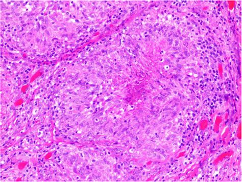 H E Section Demonstrating Necrotising Granulomatous Inflammation