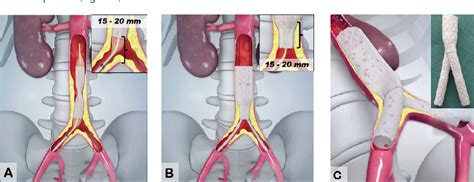 Figure From Covered Endovascular Reconstruction Of Aortic Bifurcation