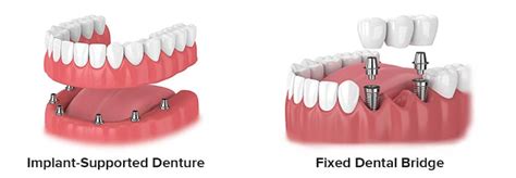 How Many Dental Implants Do I Need For A Denture Or Fixed Bridge